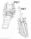 Fig. 04 - Pivotal bone anchor receiver assembly with threaded closure