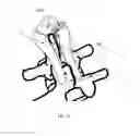 Fig. 08 - Cervical spinous process staple
