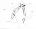 Fig. 12 - Cervical spinous process staple