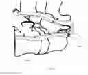 Fig. 15 - Cervical spinous process staple