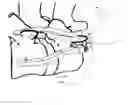 Fig. 16 - Cervical spinous process staple