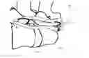 Fig. 17 - Cervical spinous process staple