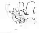 Fig. 18 - Cervical spinous process staple