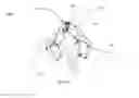 Fig. 20 - Cervical spinous process staple