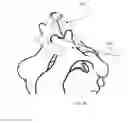 Fig. 24 - Cervical spinous process staple
