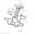 Fig. 32 - Cervical spinous process staple