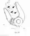 Fig. 37 - Cervical spinous process staple