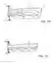 Fig. 25 - Implantable electroacupuncture system and method for treating parkinson's disease and essential tremor through application of stimului at or near an acupoint on the chorea line