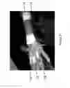 Fig. 22 - Method for functional electrical stimulation therapy