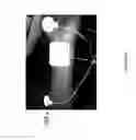 Fig. 49 - Method for functional electrical stimulation therapy