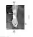 Fig. 55 - Method for functional electrical stimulation therapy