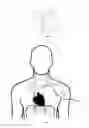 Fig. 05 - Apparatus and methods for assisted breathing by transvascular nerve stimulation