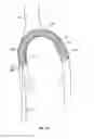 Fig. 08 - Plain woven stents