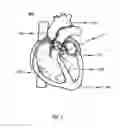 Fig. 02 - Catheter delivery system for heart valve prosthesis