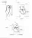 Fig. 03 - Catheter delivery system for heart valve prosthesis
