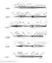 Fig. 06 - Catheter delivery system for heart valve prosthesis