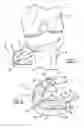 Fig. 02 - Method and apparatus for pre-forming a high tibial osteotomy
