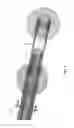 Fig. 04 - Method and apparatus for manipulating the side wall of a body lumen or body cavity so as to provide increased visualization of the same and/or increased access to the same, and/or for stabilizing instruments relative to the same