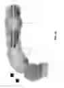 Fig. 19 - Method and apparatus for manipulating the side wall of a body lumen or body cavity so as to provide increased visualization of the same and/or increased access to the same, and/or for stabilizing instruments relative to the same