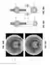 Fig. 22 - Method and apparatus for manipulating the side wall of a body lumen or body cavity so as to provide increased visualization of the same and/or increased access to the same, and/or for stabilizing instruments relative to the same