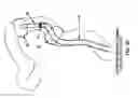 Fig. 30 - Method and apparatus for manipulating the side wall of a body lumen or body cavity so as to provide increased visualization of the same and/or increased access to the same, and/or for stabilizing instruments relative to the same