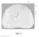 Fig. 02 - Three-dimensional optical imaging and therapy of prostate cancer
