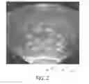 Fig. 03 - Three-dimensional optical imaging and therapy of prostate cancer