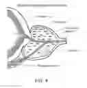Fig. 05 - Three-dimensional optical imaging and therapy of prostate cancer