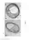 Fig. 02 - Detection of lipid core plaque cap thickness