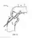 Fig. 06 - Tissue graft fixation