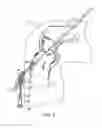 Fig. 07 - Tissue graft fixation