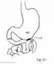 Fig. 22 - Methods for diagnosing and delivering therapeutic interventions in the peritoneal cavity
