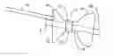 Fig. 01 - Gastric retaining devices and methods