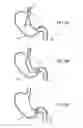 Fig. 08 - Gastric retaining devices and methods
