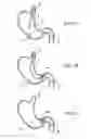 Fig. 09 - Gastric retaining devices and methods
