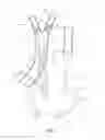 Fig. 02 - Method and apparatus for treating a carotid artery