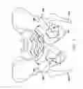 Fig. 02 - Inside-out guide for hip replacement method