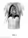 Fig. 02 - NESTED CANNULA DEVICE FOR LUNG COLLAPSE