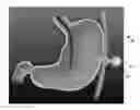 Fig. 01 - Transabdominal gastric device and method