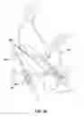 Fig. 30 - Transabdominal gastric device and method