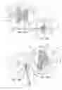 Fig. 14 - Systems and methods for posterior dynamic stabilization of the spine