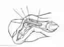 Fig. 01 - Cortical bone pin