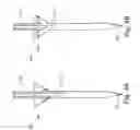 Fig. 06 - Pressure Wave Root Canal Cleaning System