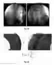 Fig. 24 - Bioerodible wraps and uses therefor