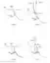 Fig. 03 - Methods of implanting orthopedic devices