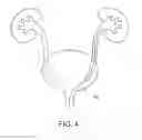 Fig. 05 - STENT PUSHER ASSEMBLY