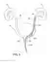 Fig. 06 - STENT PUSHER ASSEMBLY