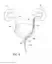 Fig. 07 - STENT PUSHER ASSEMBLY