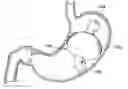 Fig. 01 - Reactive intragastric implant devices
