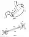 Fig. 07 - Reactive intragastric implant devices